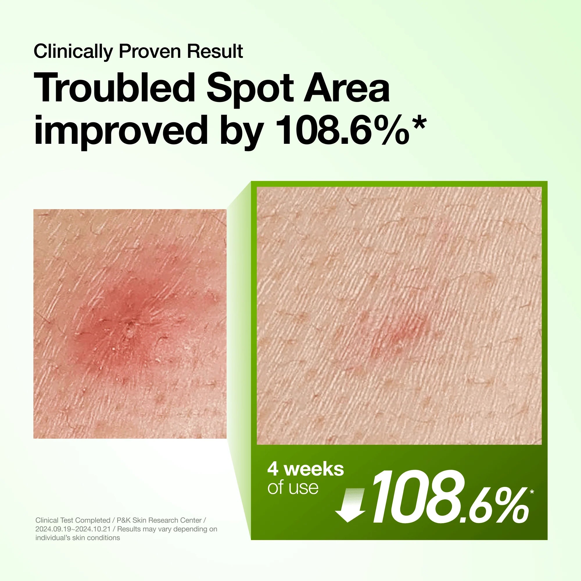 ANUA – Azelaic Acid 10 Hyaluron Redness Soothing Serum (30ml)